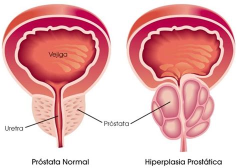 Más riesgo de cáncer de próstata y vejiga en pacientes con HBP