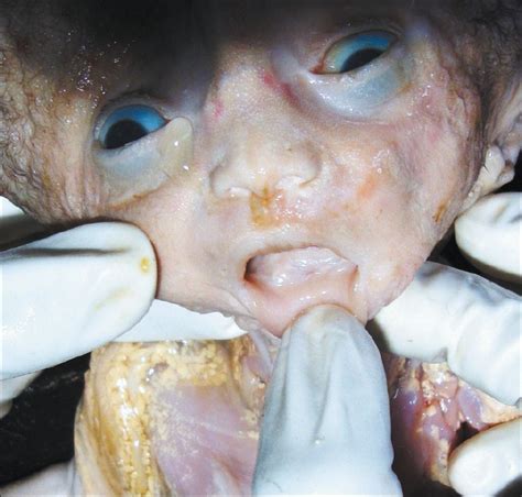Massive congenital intracranial immature teratoma: An autopsy report ...