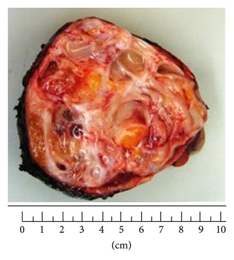 Mature  benign  cystic retroperitoneal teratoma in the region of left ...