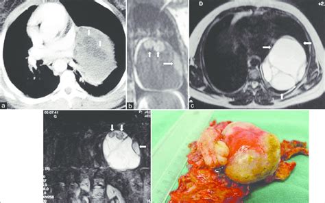 Mature cystic teratoma in a 20 year old female who had chest pain and ...