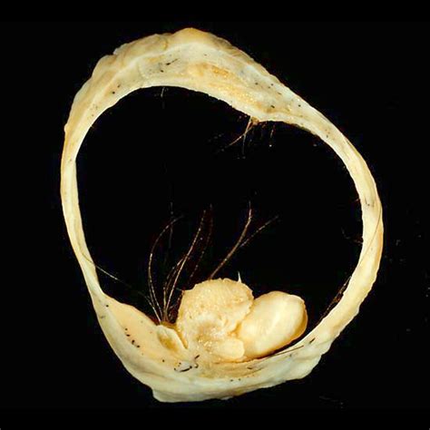 Mature cystic teratoma of the ovary | Image | Radiopaedia.org