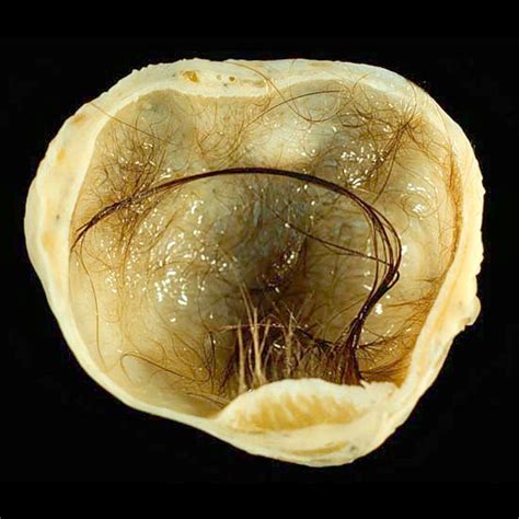 Mature cystic teratoma of the ovary | Image | Radiopaedia.org