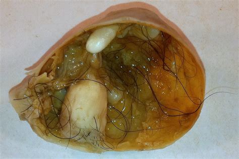 Mature Cystic Teratoma of the Ovary | Incidental finding at … | Flickr