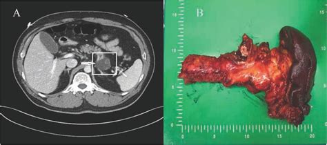 Mature cystic teratoma of the pancreas: A rare cystic neoplasm in: Open ...