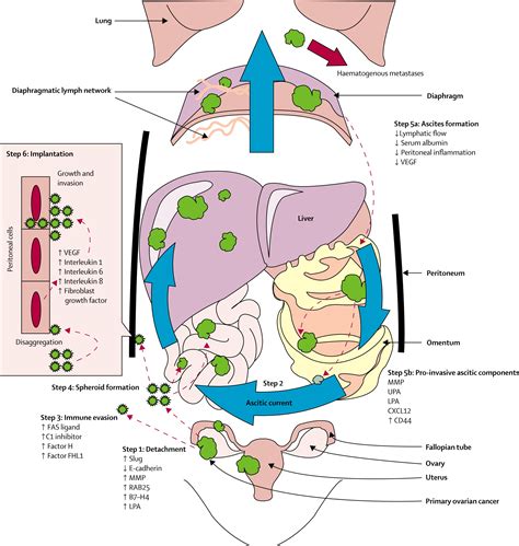 Mechanisms of transcoelomic metastasis in ovarian cancer ...