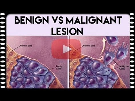 Medical Coding Basics — Benign vs. Malignant Lesion   YouTube