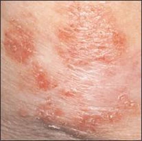 Medical Treatment Pictures for Better Understanding: Skin ...