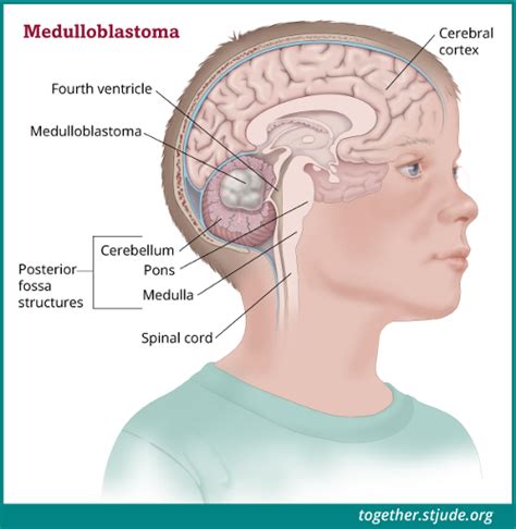 Medulloblastoma in Children and Teens   Together