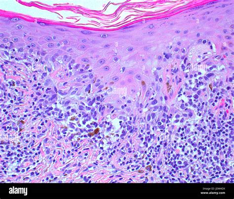 Melanoma maligno fotografías e imágenes de alta resolución Alamy