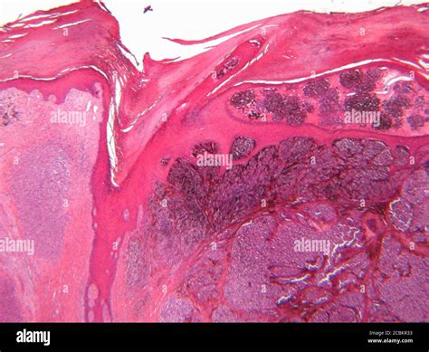 Melanoma maligno fotografías e imágenes de alta resolución Alamy