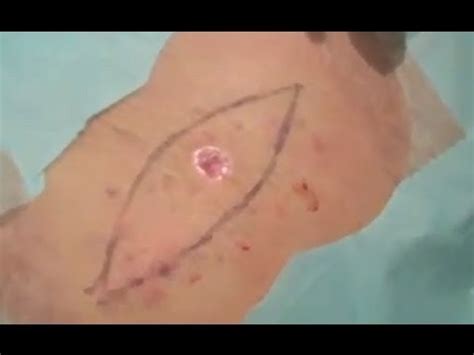 Melanoma Removal   GRAPHIC [DermTV Epi #467]   YouTube