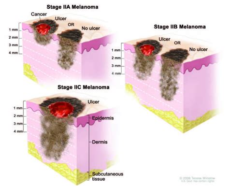 stages melanoma situ