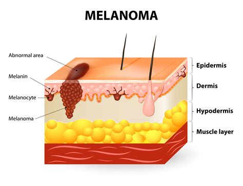 Melanoma: un tumor agresivo que se esparce rápidamente | La Opinión