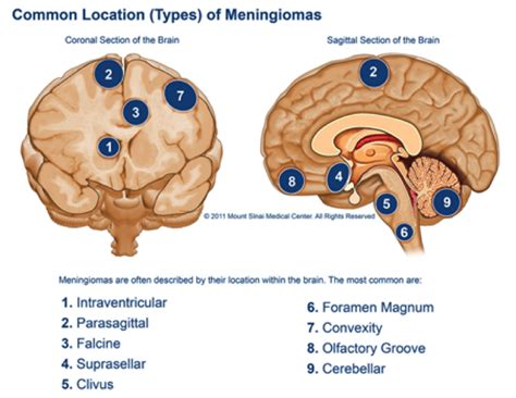 Meningioma | Neurosurgery Tasmania