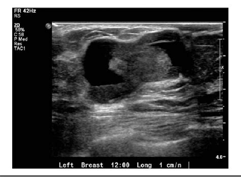 Meniu principal, Intraductal papilloma of breast left