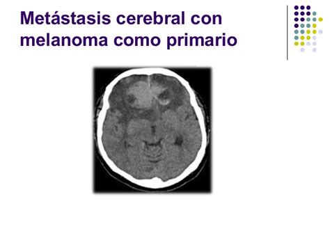 Metastasis cerebral