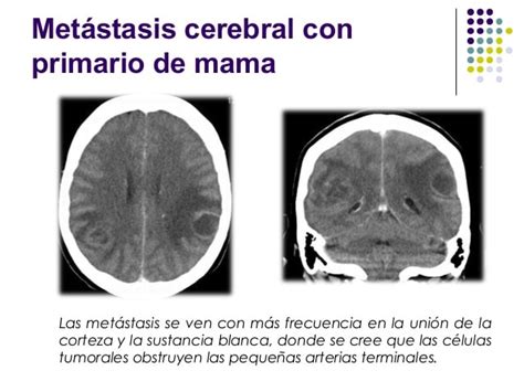 Metastasis cerebral