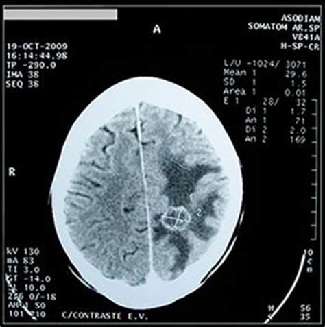 Metástasis cerebrales: Consideraciones generales y ...