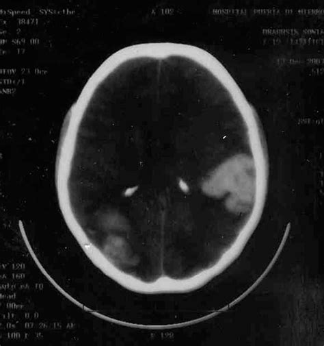 Metástasis cerebrales de coriocarcinoma tras una gestación ...