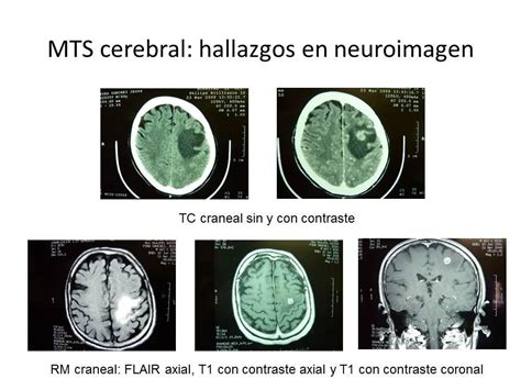Metástasis cerebrales | NeuroWikia