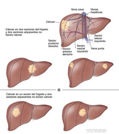Metástasis hepáticas en cáncer de colon. Por qué el hígado ...