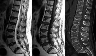 Metástasis: Las lesiones en múltiples cuerpos vertebrales ...