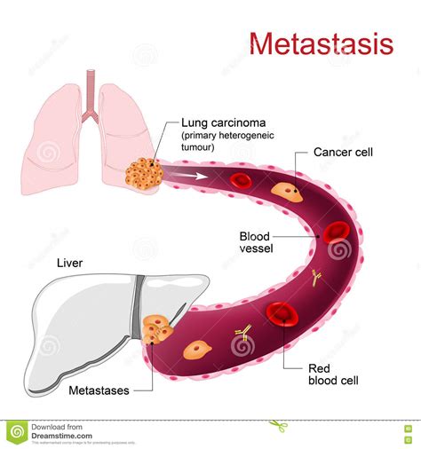 Metastasis. Metastases Stock Vector   Image: 72369455