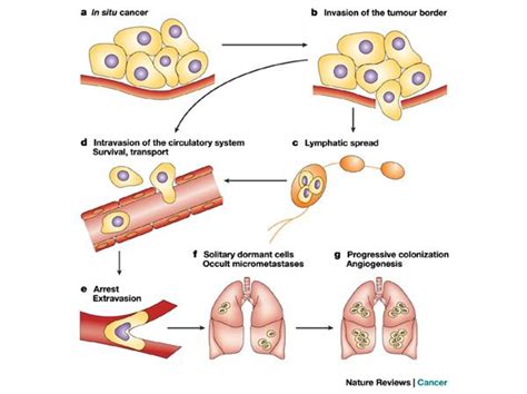 metastasis. Metastatic cancer cells that have spread ...