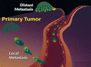 Metastasis of cancer | ENCOGNITIVE.COM