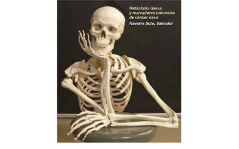 Metástasis óseas by Salvador Navarro Soto on Prezi