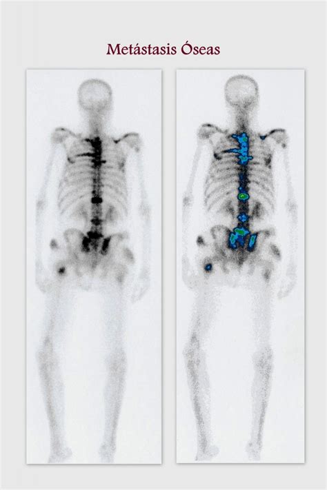 Metástasis óseas: diagnostico por la imagen – CDI Marbella