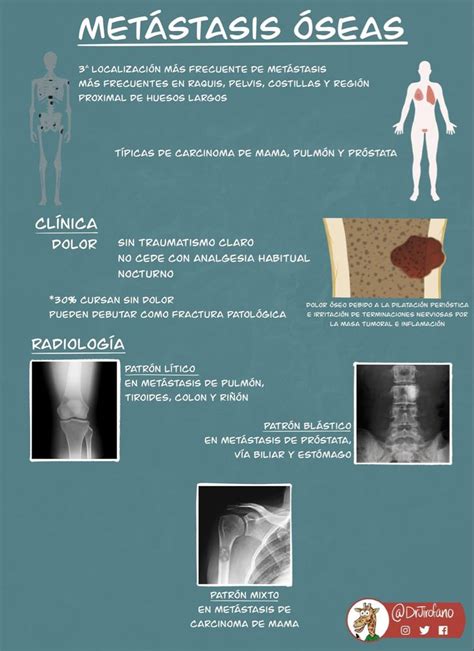 Metástasis óseas | Traumatismo, Anatomía, Dilatacion
