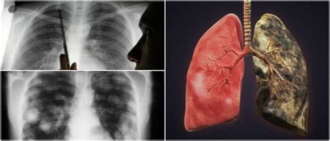 Metástasis Pulmonar: Causas, Frecuencia, Mortalidad ...
