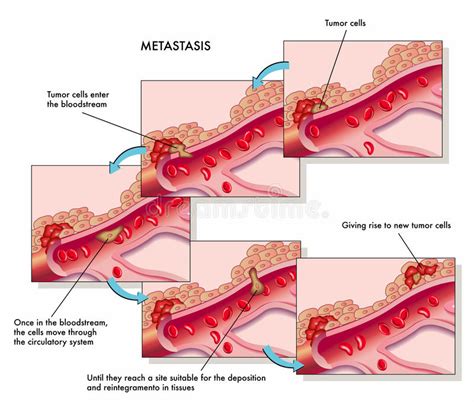 Metastasis Royalty Free Stock Images   Image: 24573929