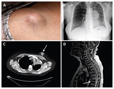 Metastatic lung cancer presenting as cutaneous nodules | CMAJ