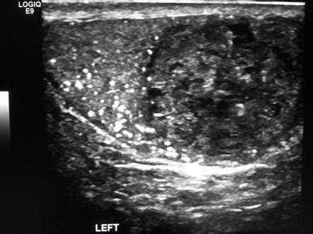 Metastatic testicular teratoma | Image | Radiopaedia.org