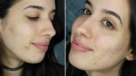 Mi historia con el acné | VoguishDiet   YouTube