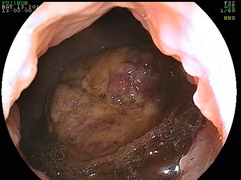 Michael Porter, Equine Veterinarian: Urinary Bladder tumor ...