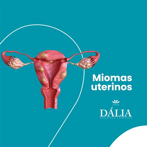 Miomas uterinos: saiba tudo sobre estes tumores Mioma uterino