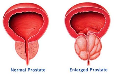 .: Mira como saber si tienes problemas en la prostata de manera sencilla