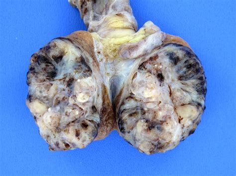 Mixed Germ Cell Tumor of the Testis | Slowly enlarging testi… | Flickr