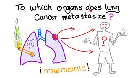 Mnemonic: Which organs does lung cancer metastasize to ...