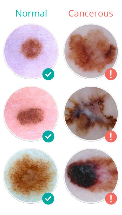 MoleScope | Skin Cancer Signs & Symptoms