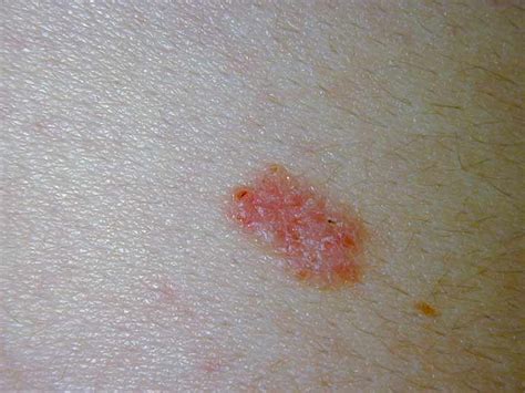 More Skin Cancer Lesions, More Risk | Medpage Today