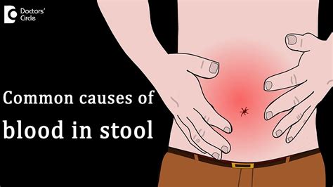 Most common causes of blood in stool   Dr. Rajasekhar M R ...