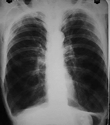 Mostra de Patologia: Enfisema Pulmonar
