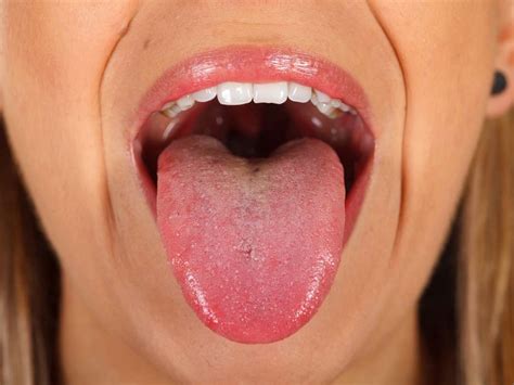 Mouth bacteria linked to esophageal cancer