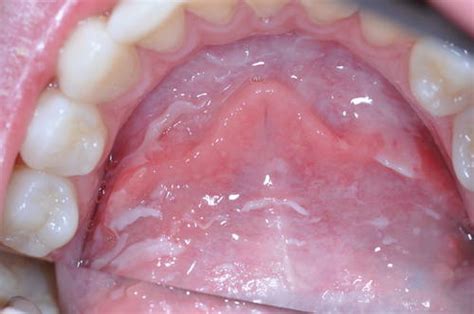 Mouth Cancer Signs and Symptoms | IYTmed.com
