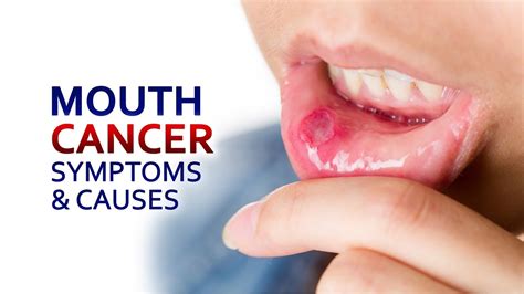 Mouth Cancer  Symptoms and Causes  Dr Anwar Amir ansari ...