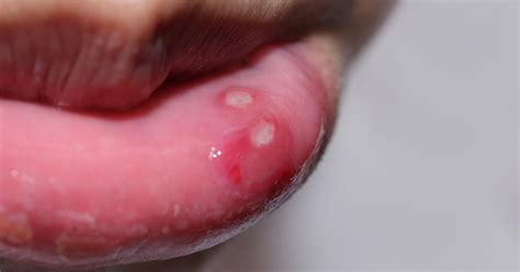 Mouth ulcers   Diagnosing mouth ulcers